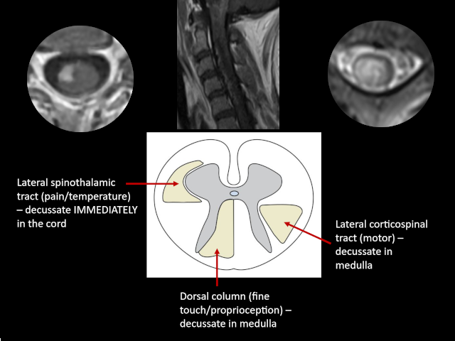 Spinal Cord Lesions