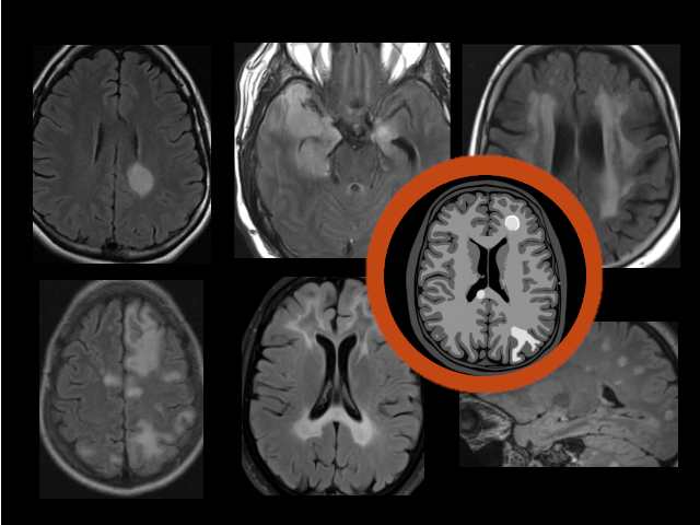 White Matter Diseases