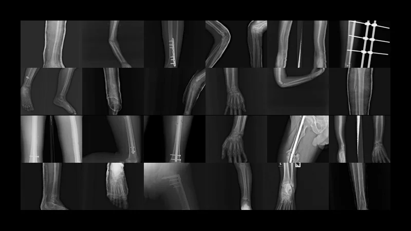 Frac-Atlas: Fracture Xray Dataset