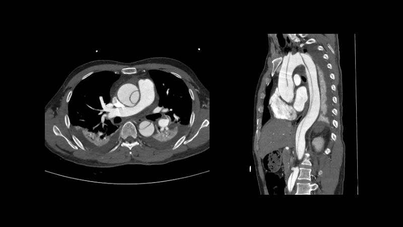 Type A Aortic Dissection (ImageTAAD)