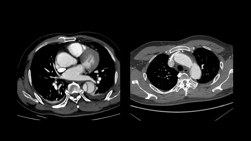 Type B Aortic Dissection (ImageTBAD)