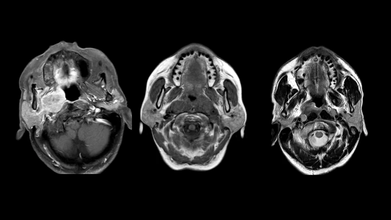 Primary Nasopharyngeal Cancer MRI