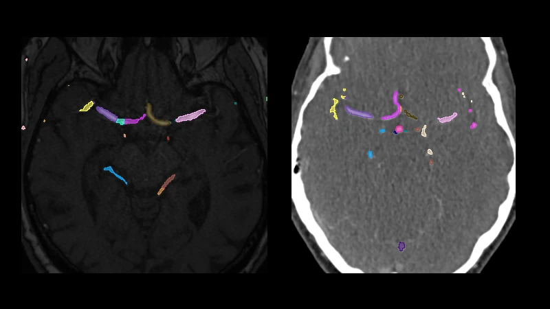 TOP-BRAIN: CTA and MRA anatomy