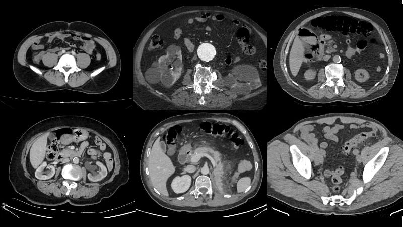 TR Abdomen: Abdominal Emergencies